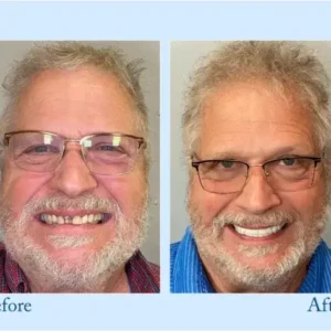 Hidone® 🦷Advanced Customized Full Denture Set🦷 (⏰Limited time discount last 30 minutes⏰)💎
