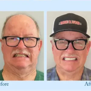 Hidone® 🦷Advanced Customized Full Denture Set🦷 (⏰Limited time discount last 30 minutes⏰)💎