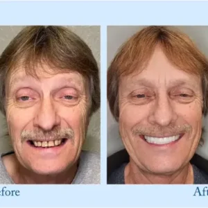 Hidone® 🦷Advanced Customized Full Denture Set🦷 (⏰Limited time discount last 30 minutes⏰)💎